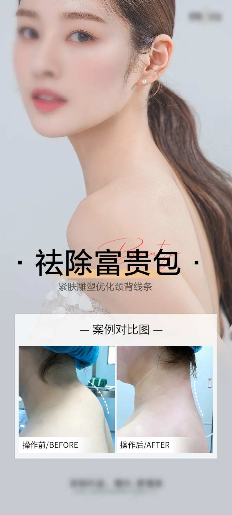 祛除富贵包案例海报-采灵感-cailinggan.com