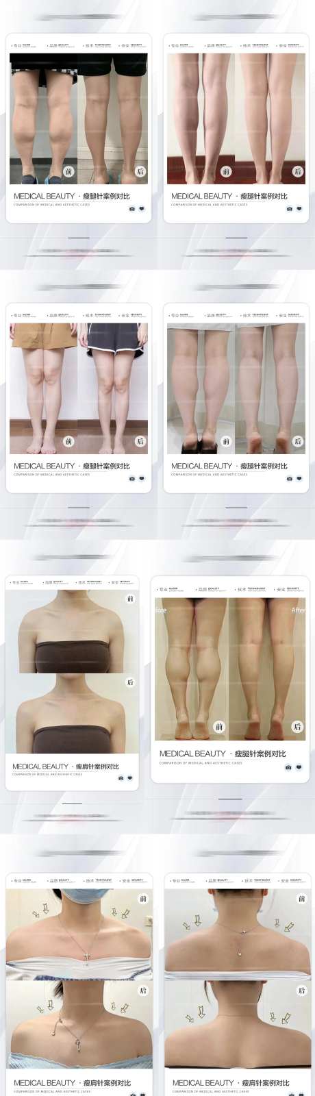 医美瘦腿瘦肩案例对比海报-采灵感-https://www.cailinggan.com/