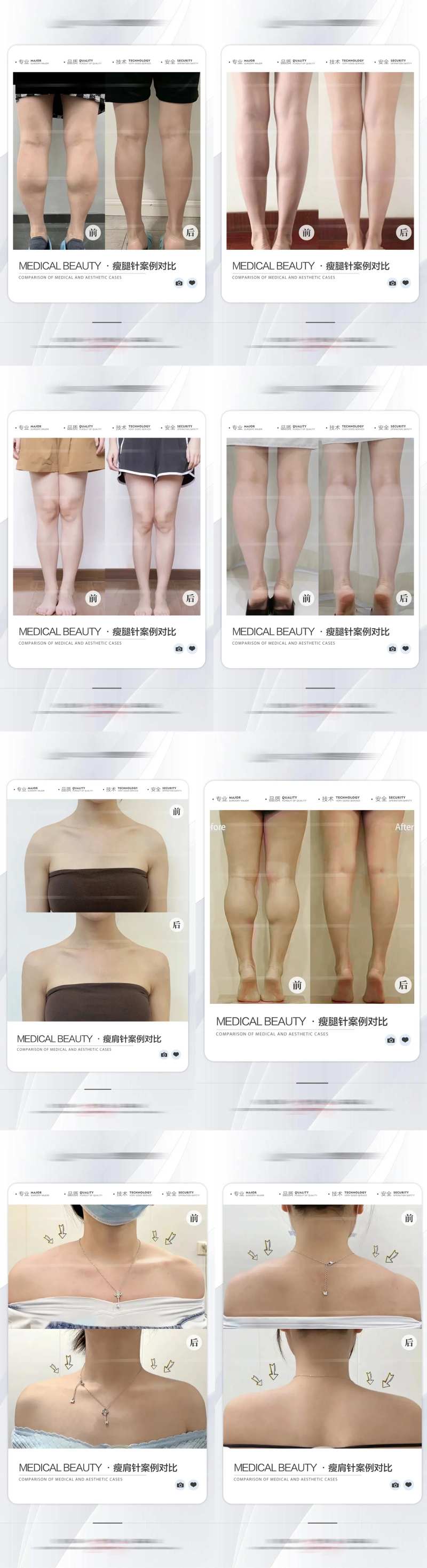 医美瘦腿瘦肩案例对比海报-采灵感-cailinggan.com