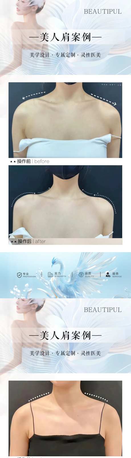 整形美人肩案例对比海报-采灵感-https://www.cailinggan.com/