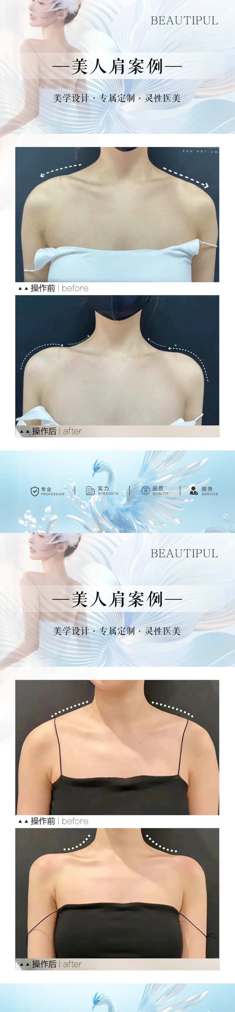 整形美人肩案例对比海报-采灵感-cailinggan.com
