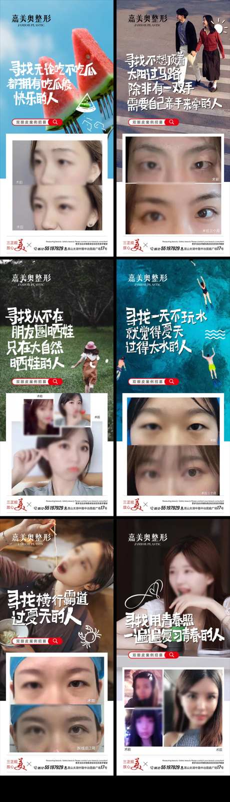 双眼皮案例招募活动术前术后对比图-采灵感-https://www.cailinggan.com/