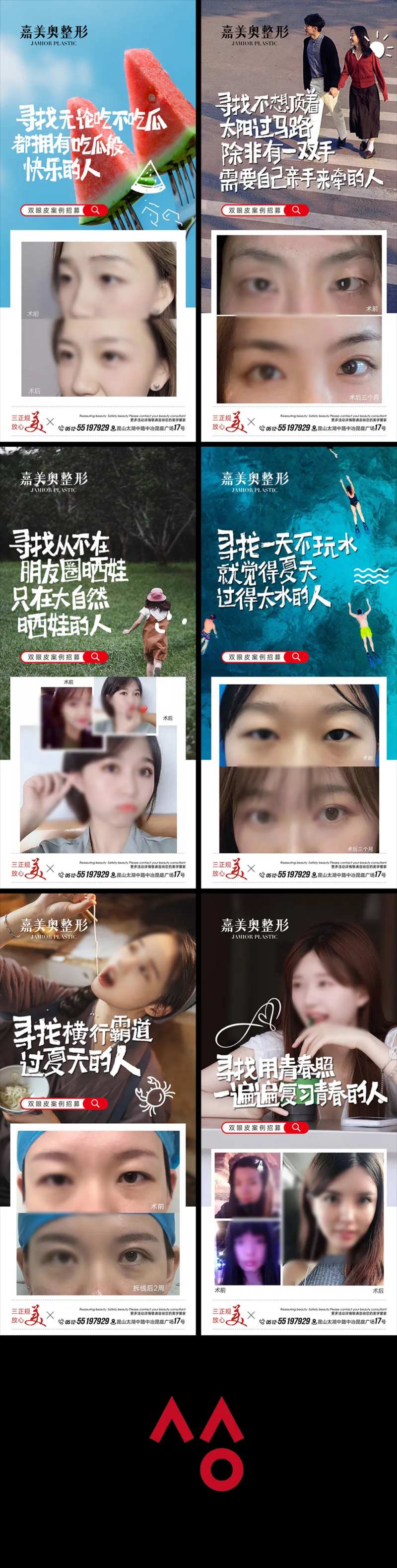 双眼皮案例招募活动术前术后对比图-采灵感-cailinggan.com