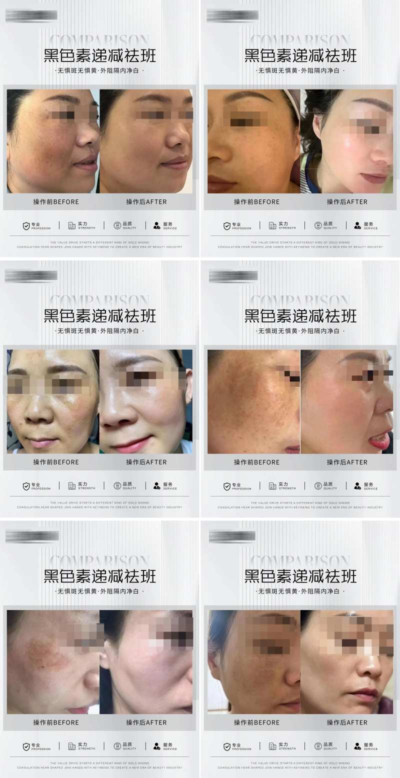 淡斑案例系列海报-采灵感-cailinggan.com