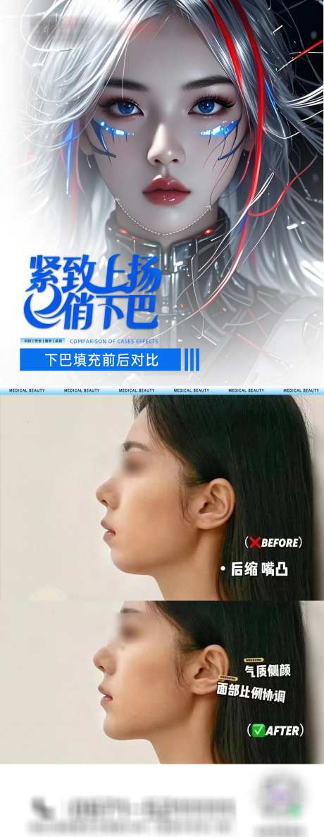医美下巴填充海报-采灵感-https://www.cailinggan.com/