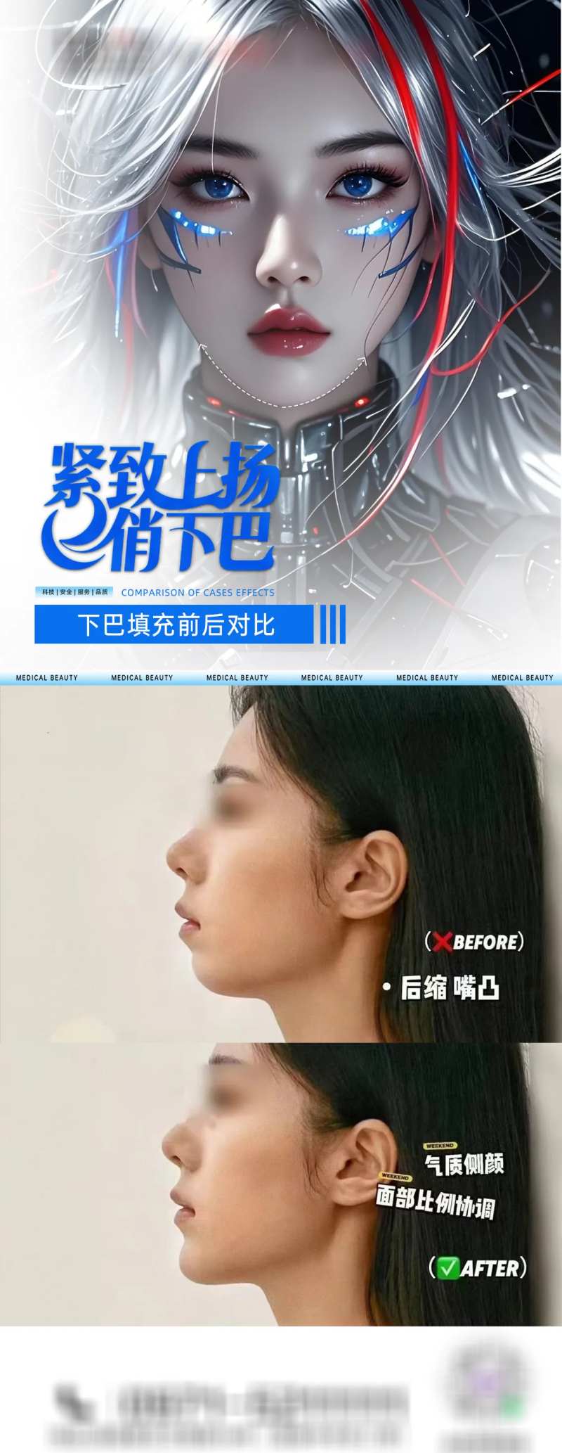 医美下巴填充海报-采灵感-cailinggan.com