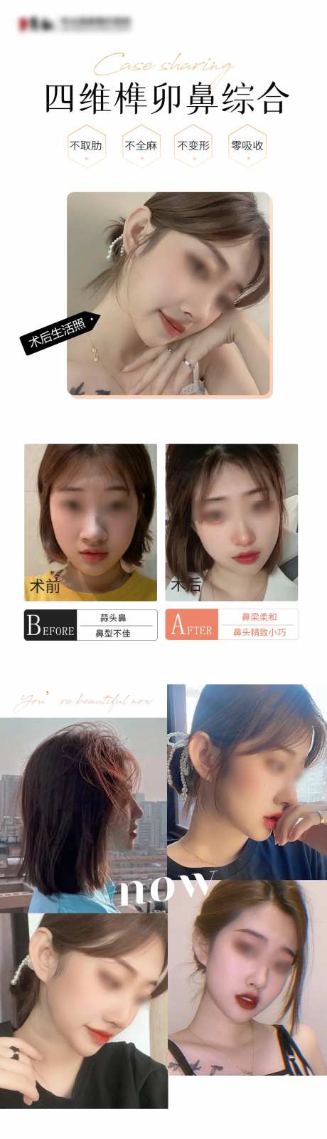 医美隆鼻对比海报-采灵感-https://www.cailinggan.com/