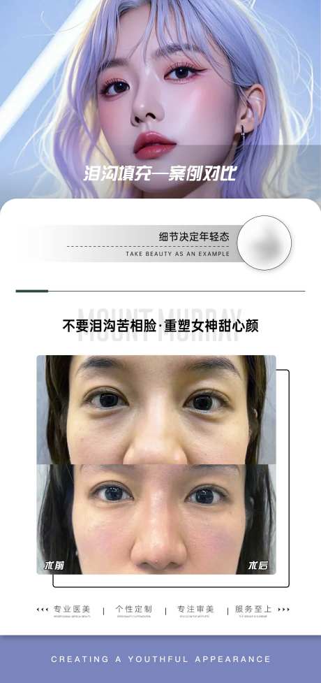 医美泪沟填充案例对比-采灵感-https://www.cailinggan.com/
