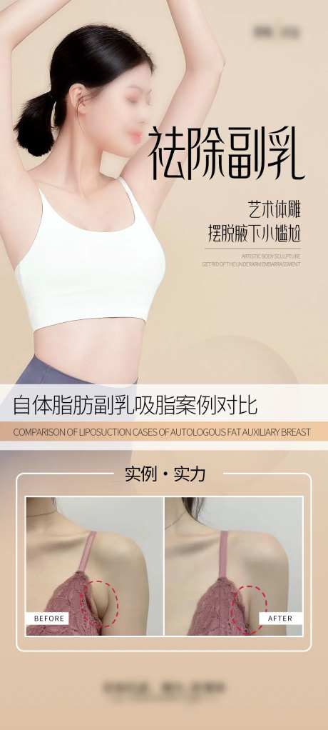 祛除副乳案例宣传海报-采灵感-https://www.cailinggan.com/