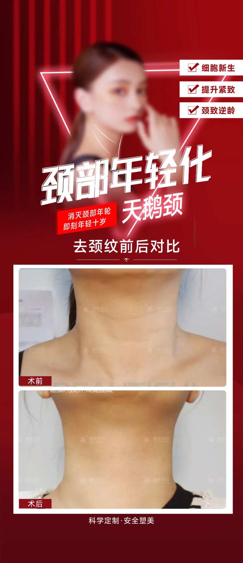 去颈纹案例-采灵感-cailinggan.com