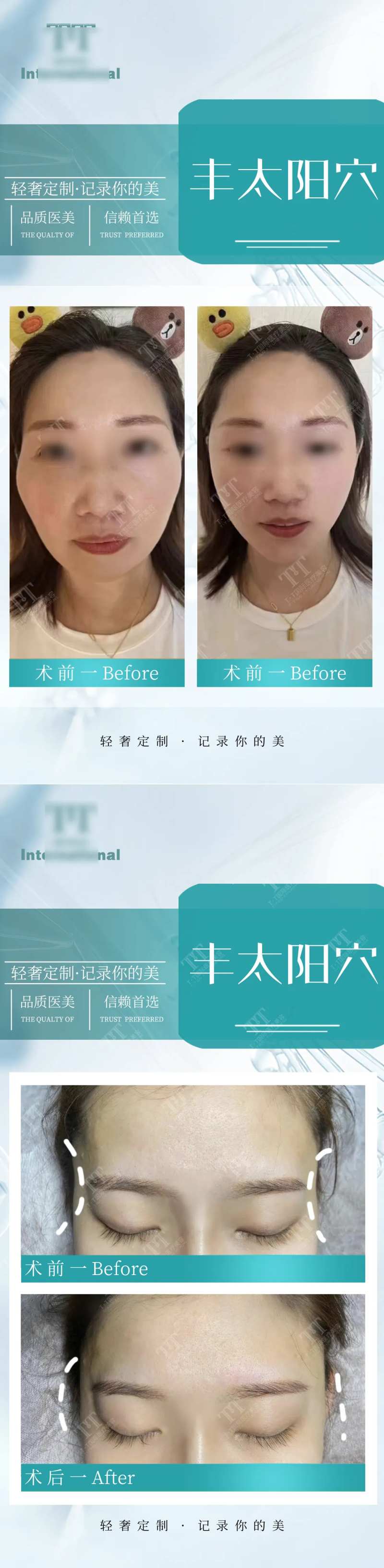 医美整形丰太阳穴案例-采灵感-cailinggan.com