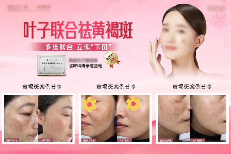 医美祛斑对比海报展板-采灵感-cailinggan.com
