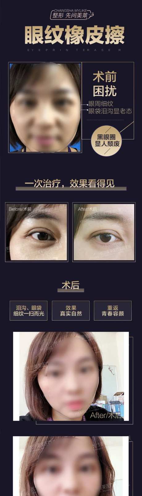 医美眼纹橡皮擦宣传海报-采灵感-https://www.cailinggan.com/