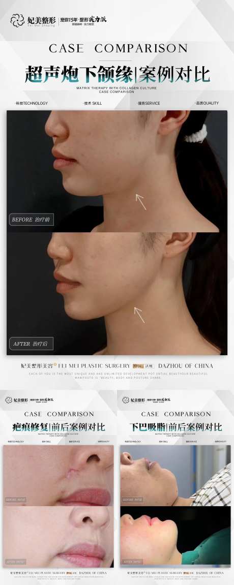 医美疤痕下巴超声炮案例-采灵感-https://www.cailinggan.com/