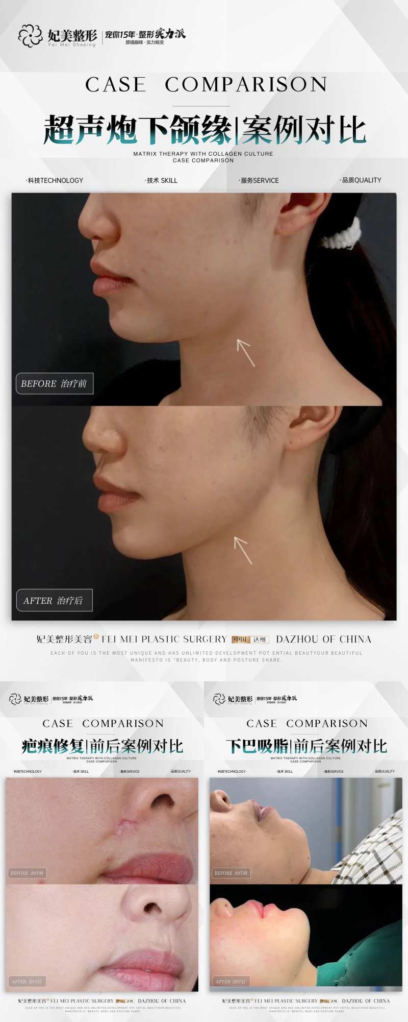 医美疤痕下巴超声炮案例-采灵感-cailinggan.com