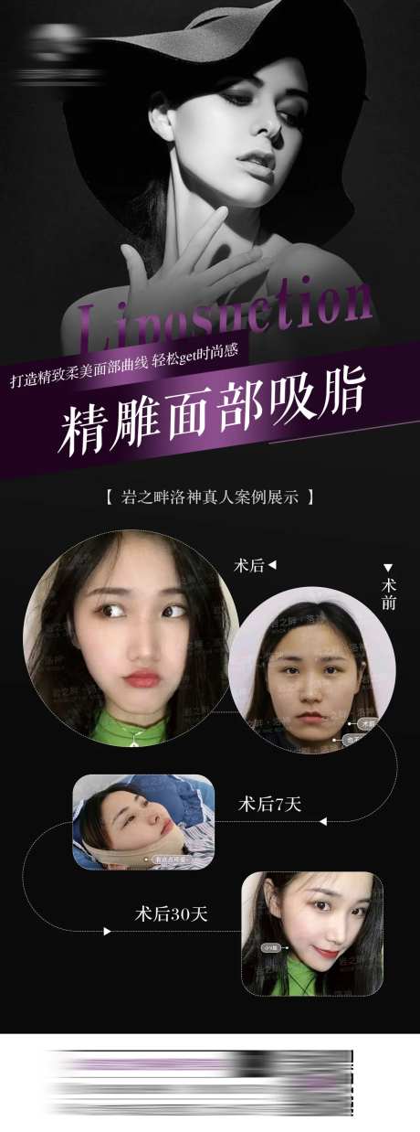 面部吸脂长图-采灵感-https://www.cailinggan.com/