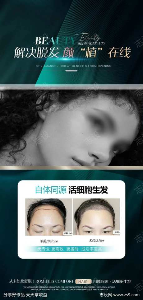 植发效果对比-采灵感-https://www.cailinggan.com/