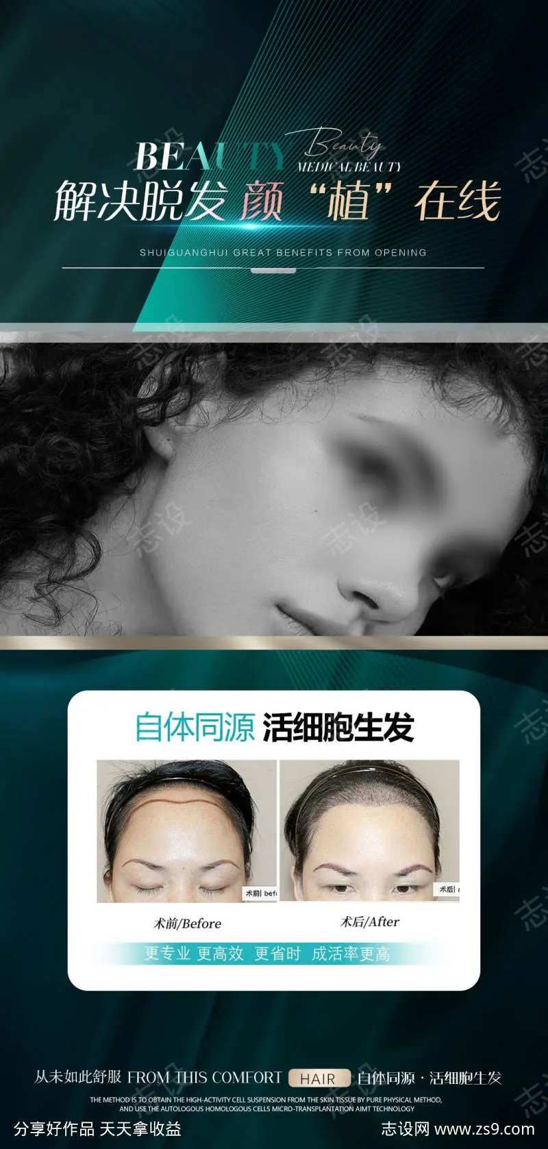 植发效果对比-采灵感-cailinggan.com