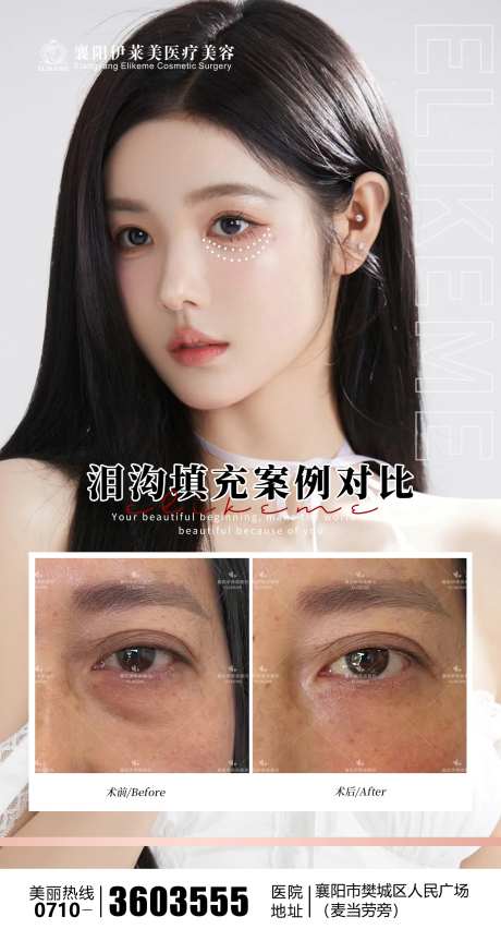 医美泪沟案例海报-采灵感-https://www.cailinggan.com/