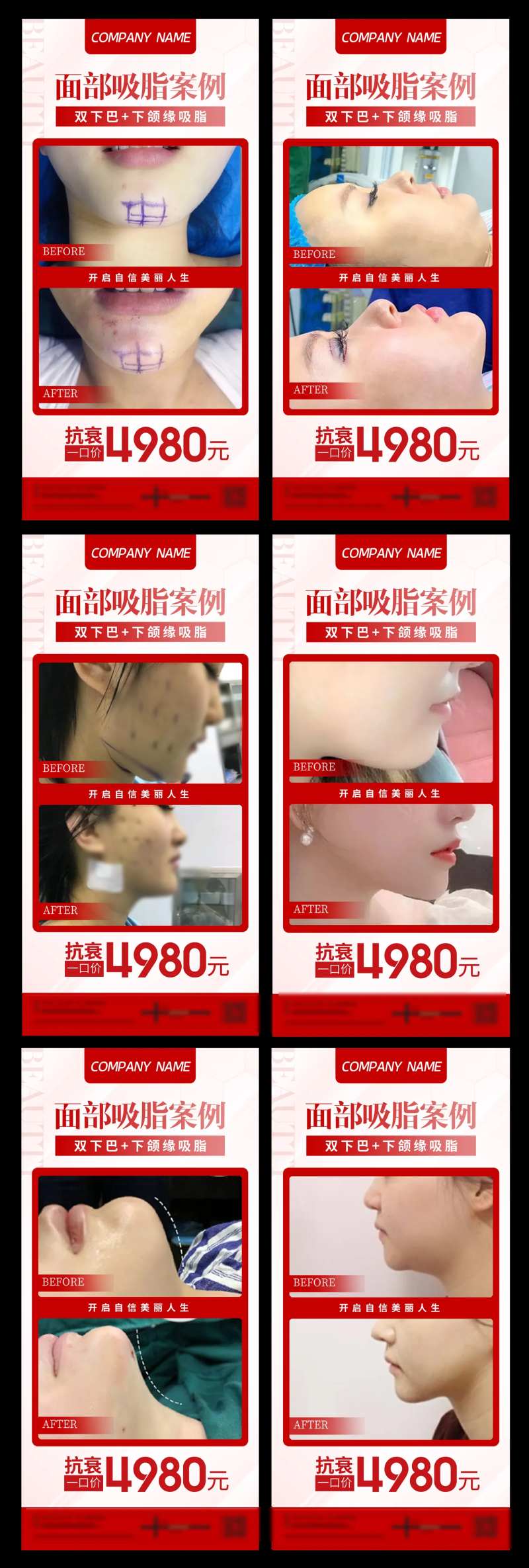 面部吸脂案例宣传系列海报-采灵感-cailinggan.com