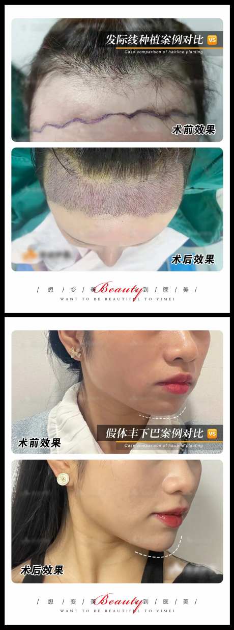 医美案例模板系列海报-采灵感-https://www.cailinggan.com/