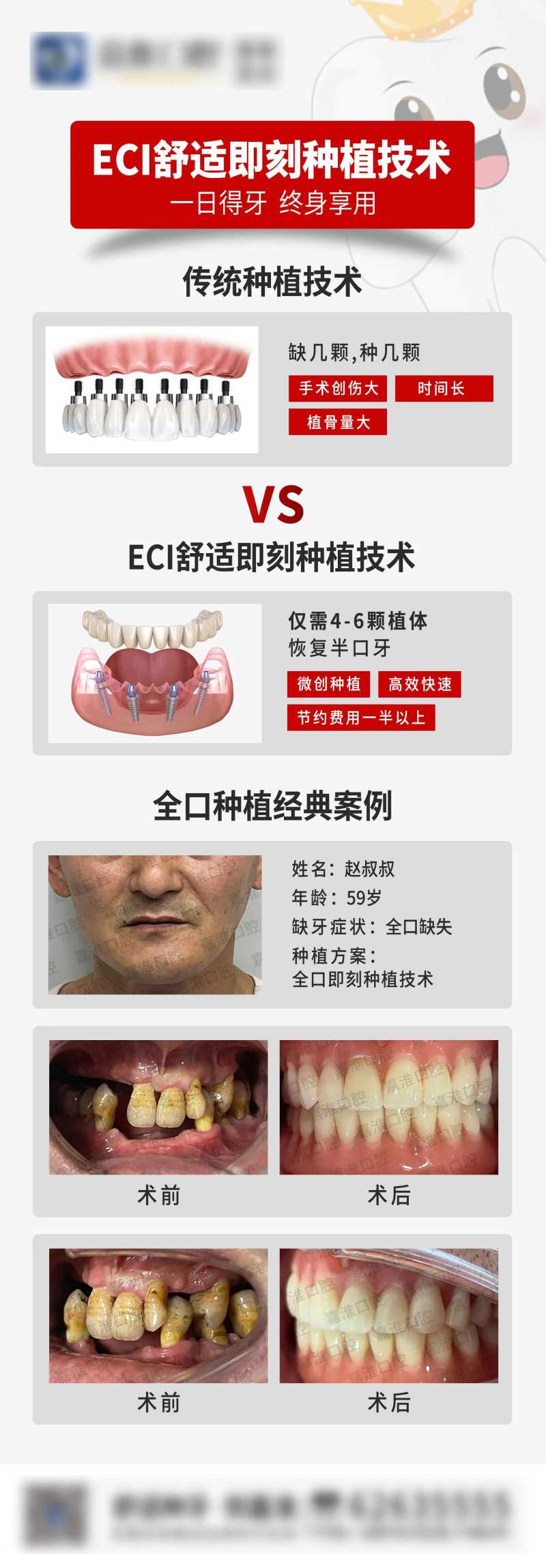 eci舒适种植牙-采灵感-cailinggan.com