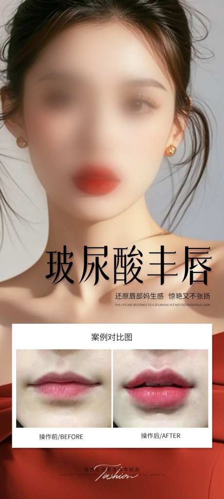 医美玻尿酸丰唇案例海报-采灵感-https://www.cailinggan.com/