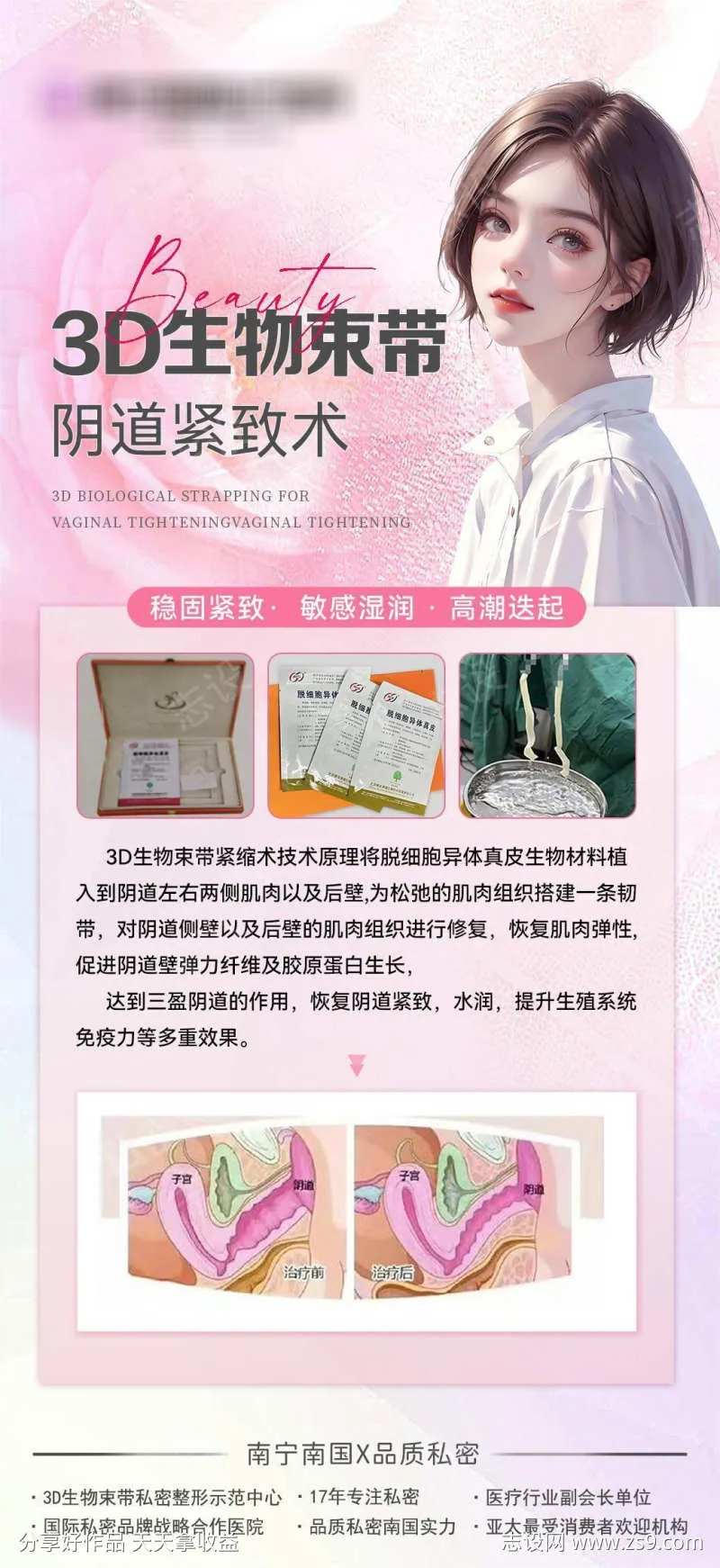 3D生物束带阴道紧致术-采灵感-cailinggan.com