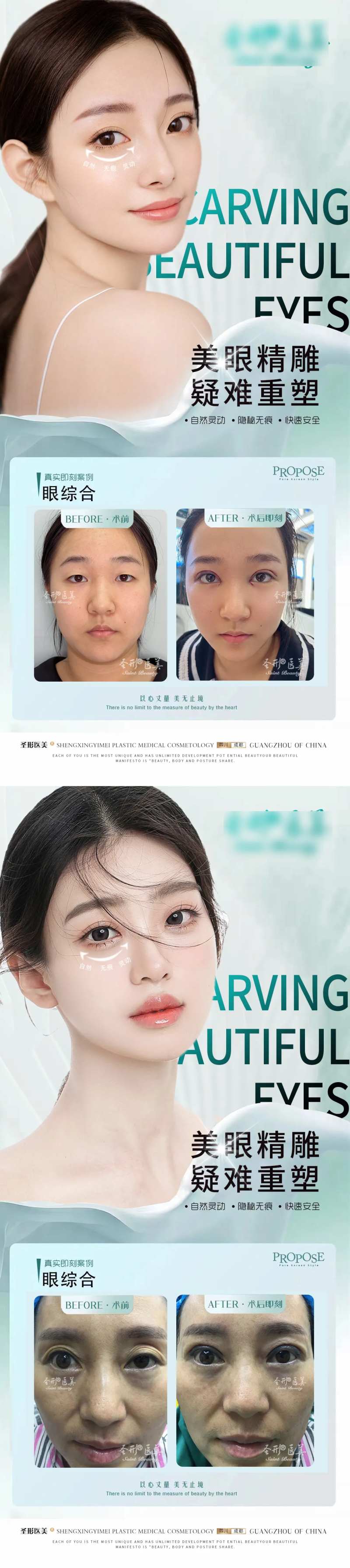 医美眼综合案例系列海报-采灵感-cailinggan.com