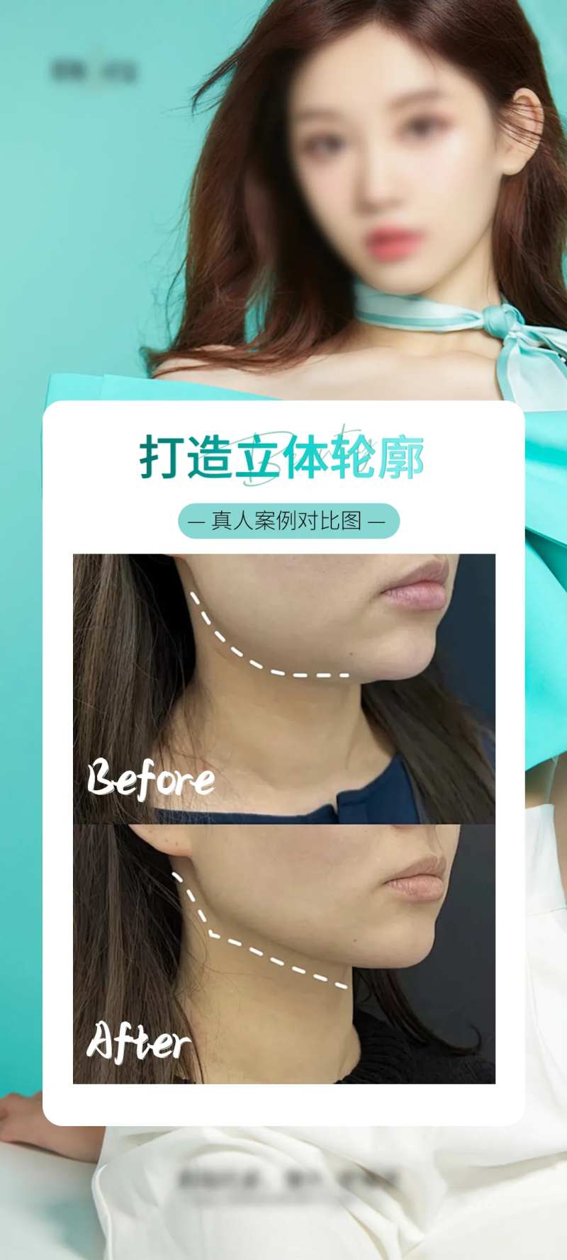 医美v脸立体轮廓海报-采灵感-cailinggan.com
