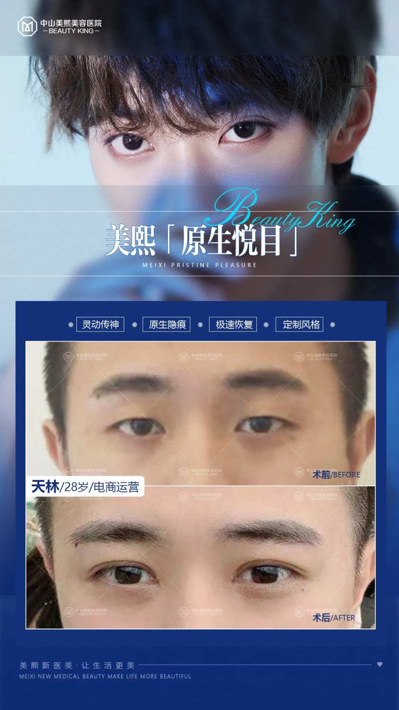 男生双眼皮案例-采灵感-cailinggan.com