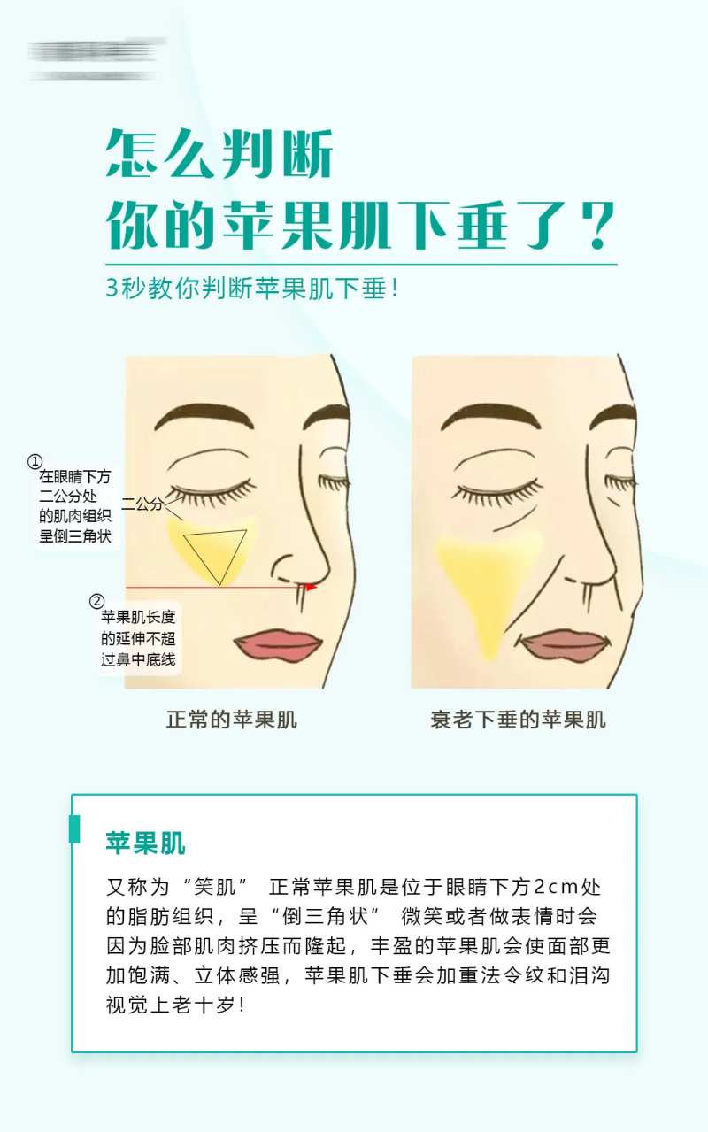 苹果肌下垂科普海报-采灵感-cailinggan.com