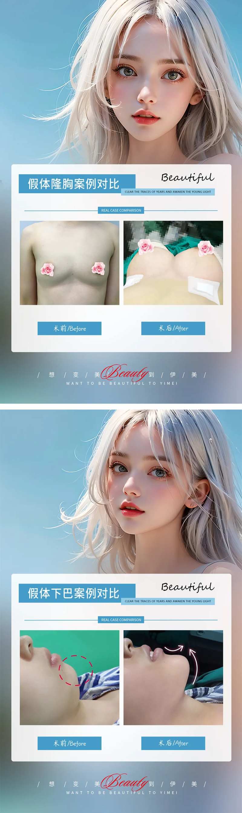 隆胸丰下巴案例对比-采灵感-cailinggan.com