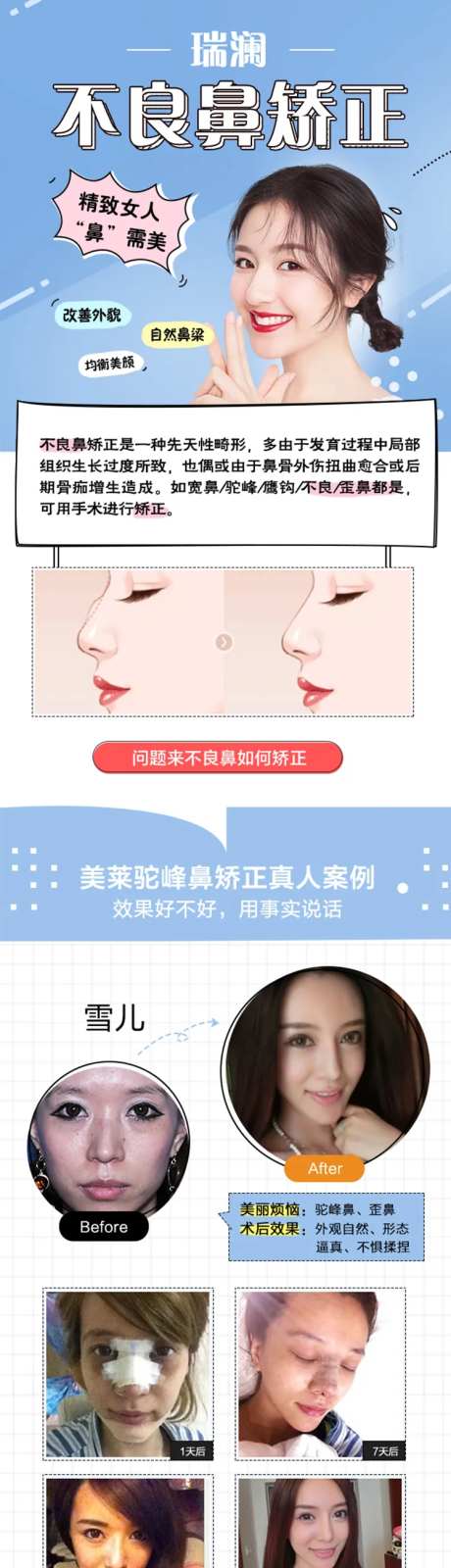 医美医院鼻子矫正详情页-采灵感-https://www.cailinggan.com/