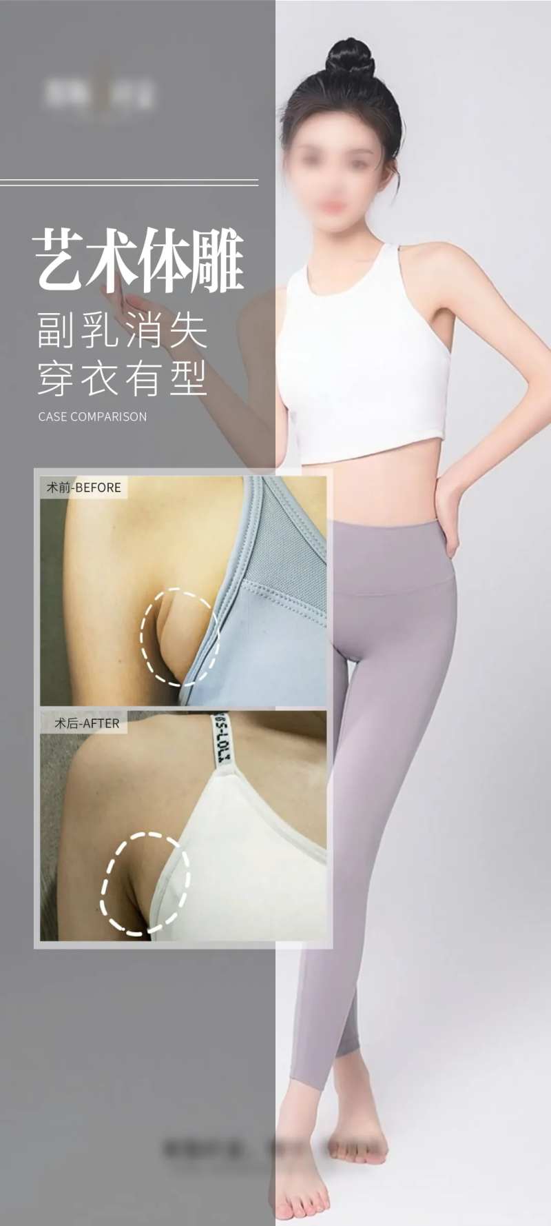 医美祛除副乳海报-采灵感-cailinggan.com