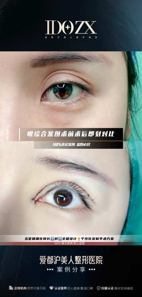 医美眼整形案例海报-采灵感-https://www.cailinggan.com/