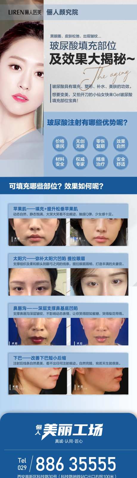 玻尿酸填充部位及效果大揭秘苹果机泪沟-采灵感-https://www.cailinggan.com/