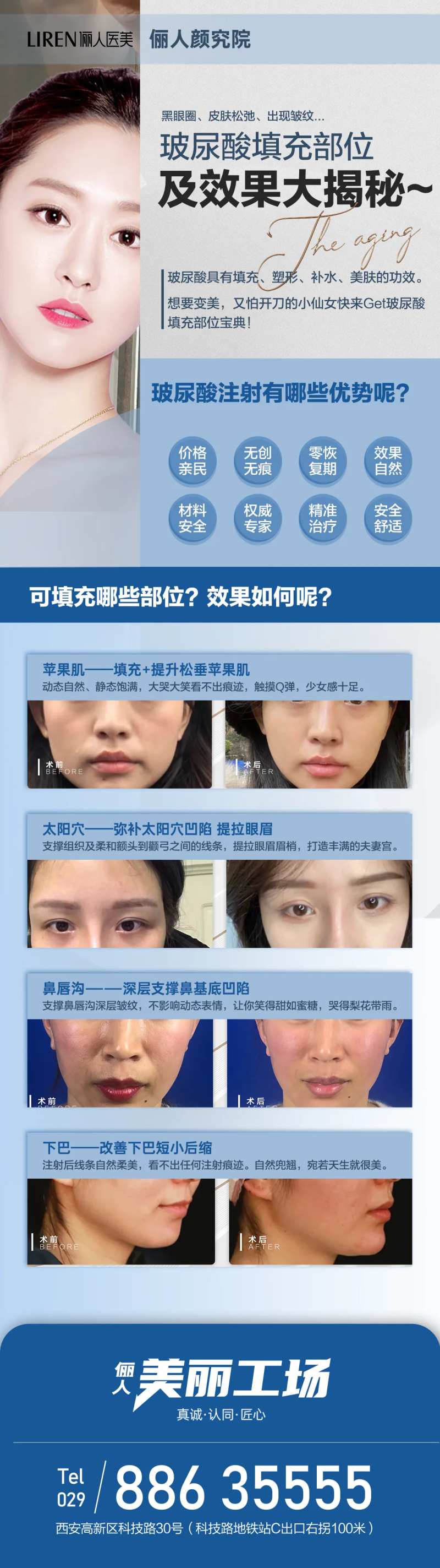 玻尿酸填充部位及效果大揭秘苹果机泪沟-采灵感-cailinggan.com