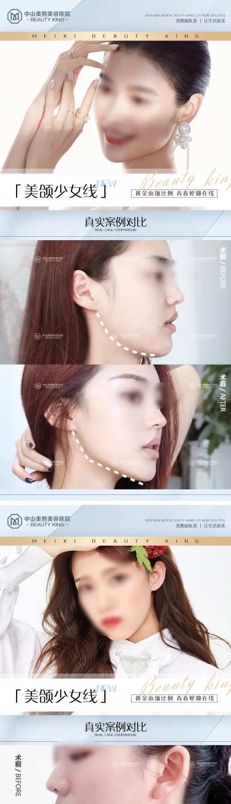 下颌线案例海报-采灵感-https://www.cailinggan.com/
