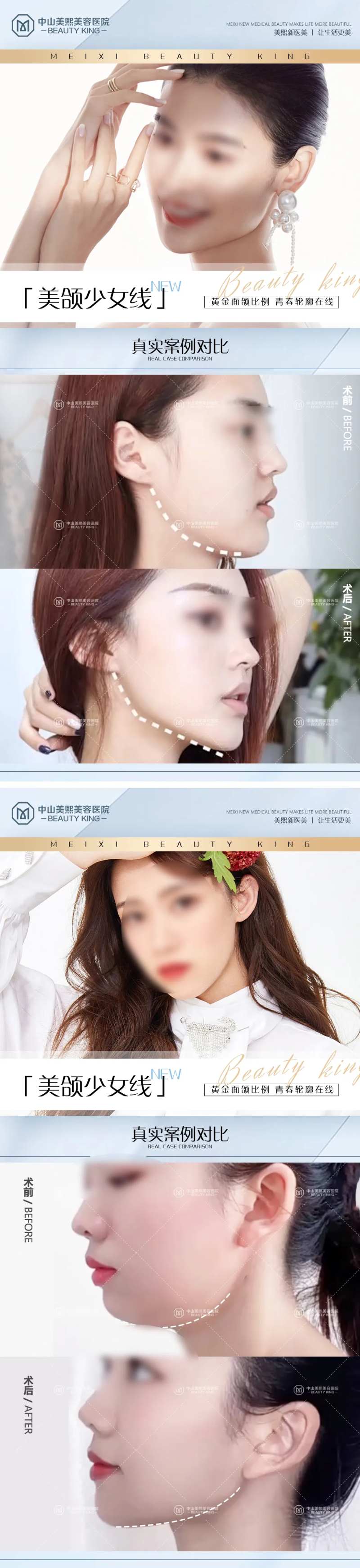 下颌线案例海报-采灵感-cailinggan.com