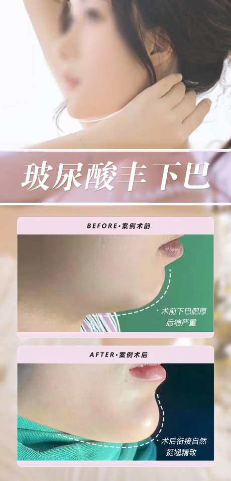 玻尿酸丰下巴海报-采灵感-https://www.cailinggan.com/