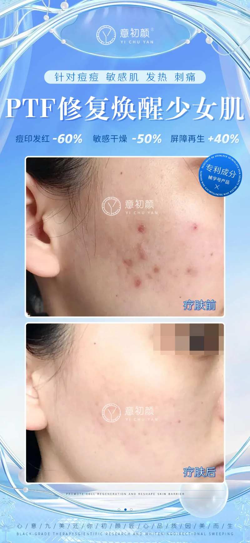 祛斑对比海报-采灵感-cailinggan.com