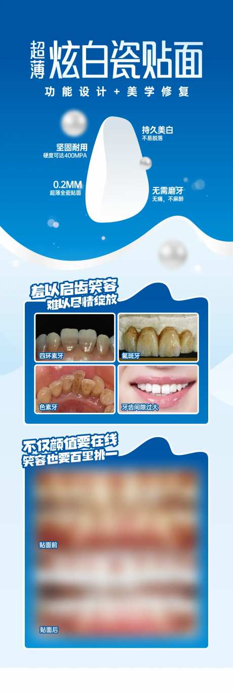 超薄瓷贴面-采灵感-https://www.cailinggan.com/