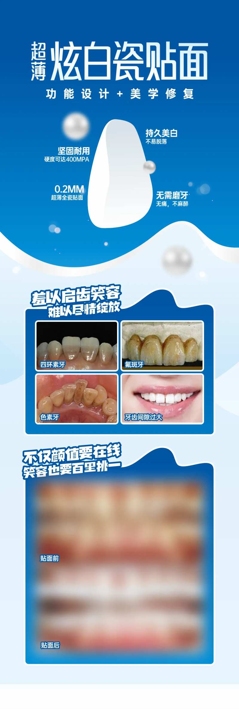 超薄瓷贴面-采灵感-cailinggan.com