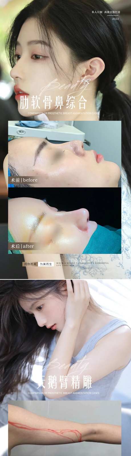 医美隆鼻吸脂整形案例系列海报-采灵感-https://www.cailinggan.com/