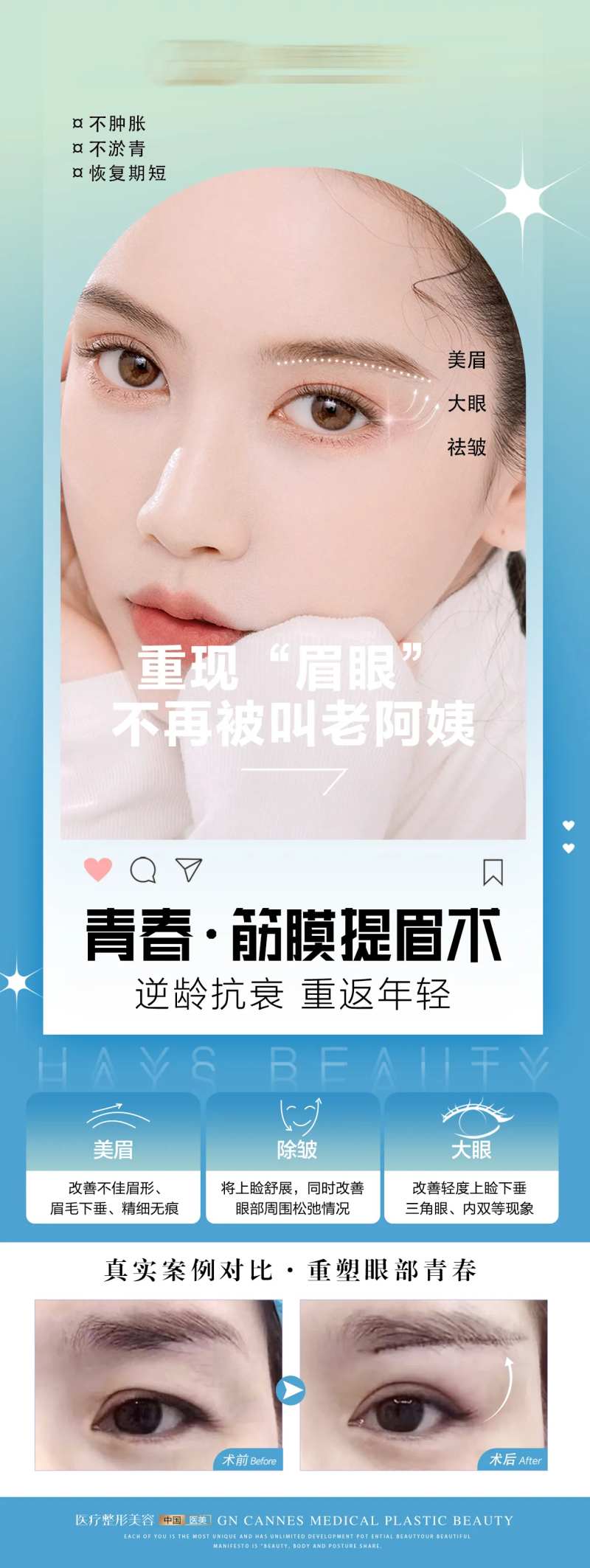 医美整形筋膜提眉术科普案例海报-采灵感-cailinggan.com