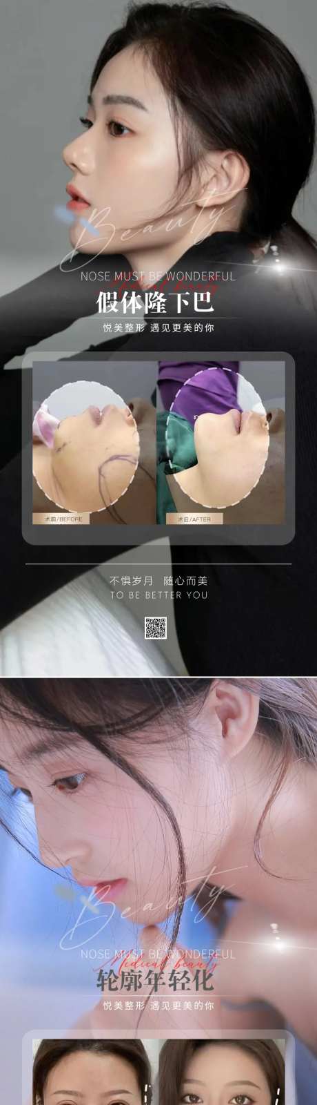 医美隆鼻案例对比图-采灵感-https://www.cailinggan.com/