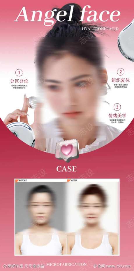 玻尿酸填充案例-采灵感-https://www.cailinggan.com/
