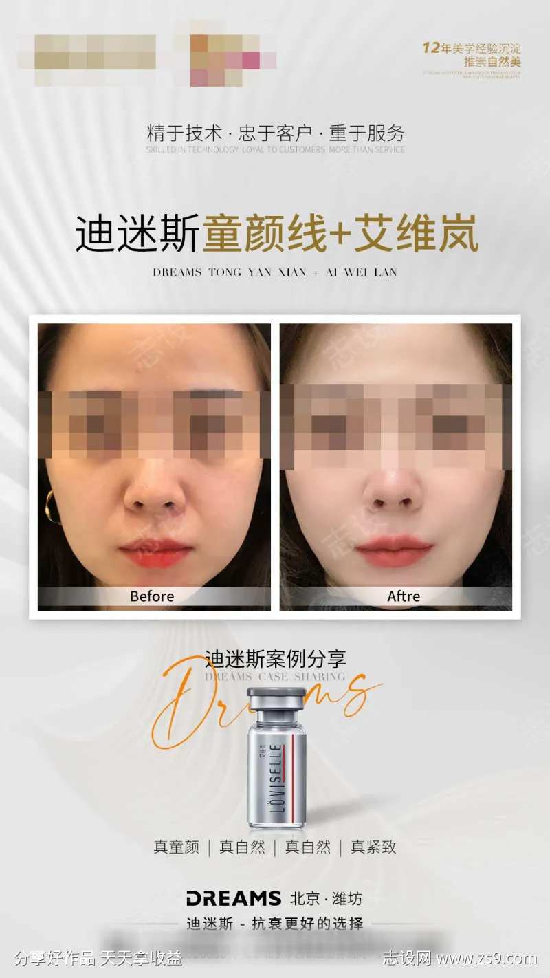 医美艾维岚线雕案例图-采灵感-cailinggan.com