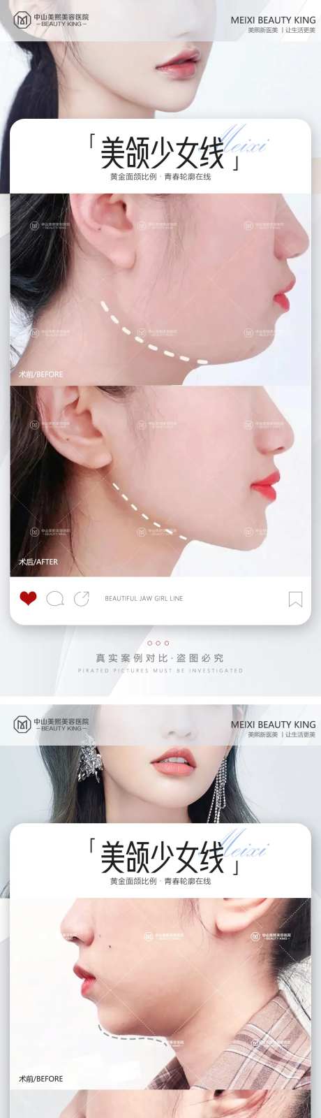 下颌线案例海报-采灵感-https://www.cailinggan.com/